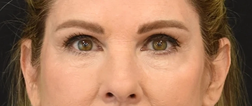 Eyelid Surgery Patient 16 Set 1 After